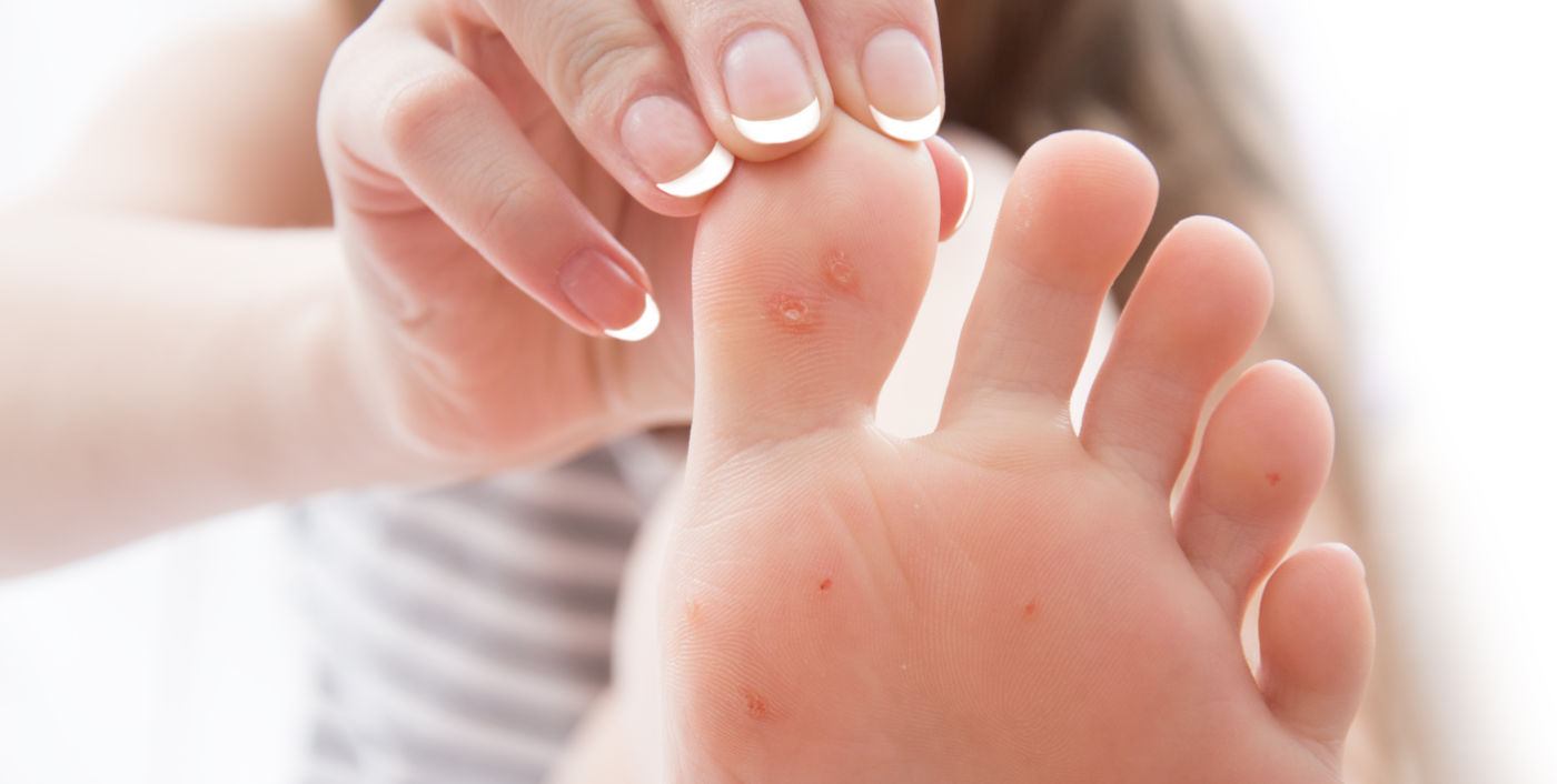 ta bort vårtor stockholm behandling