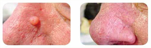 Effektiv behandling av keratos med diatermi i Stockholm